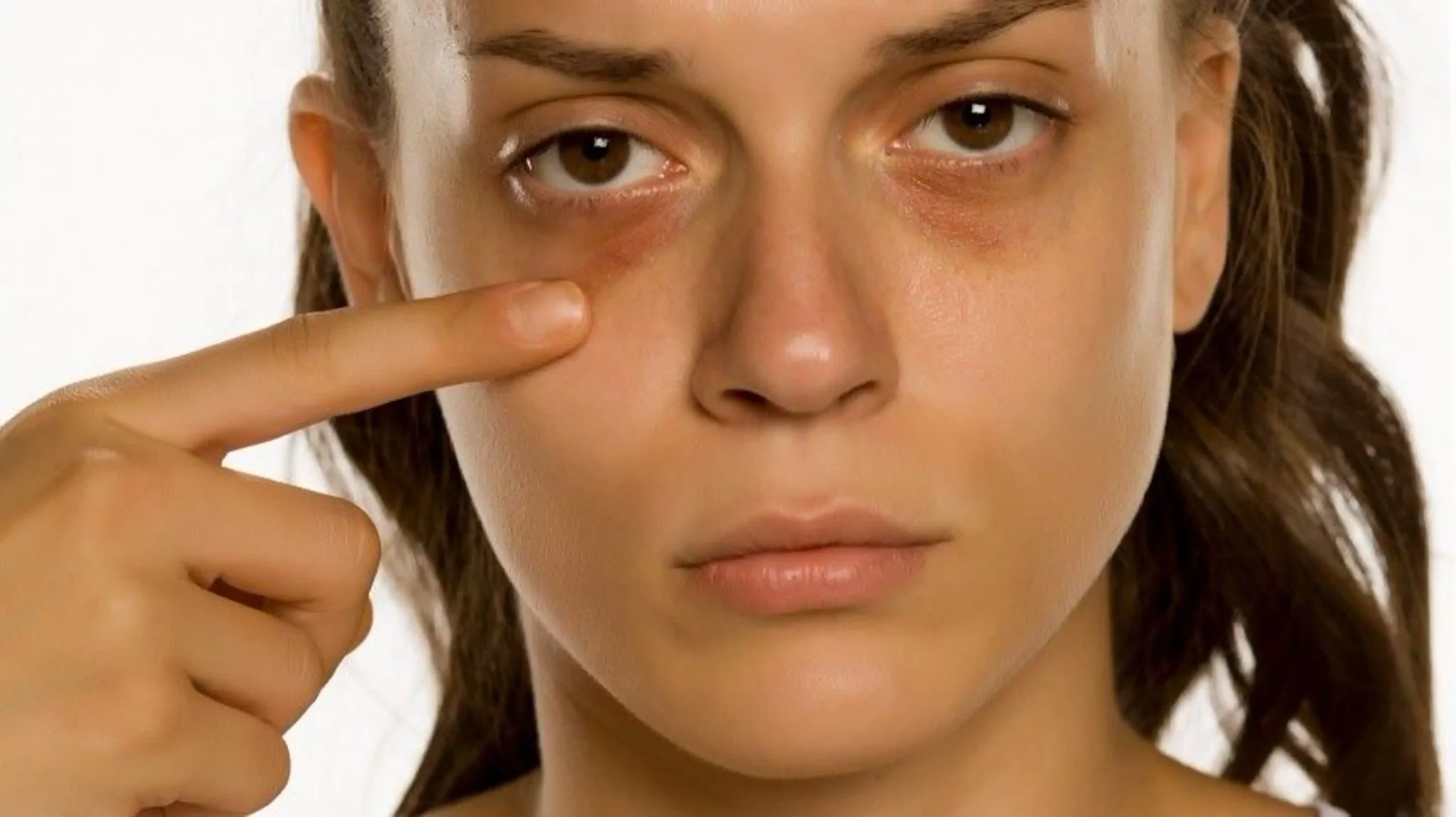 نکات تکمیلی برای کاهش سیاهی زیر چشم