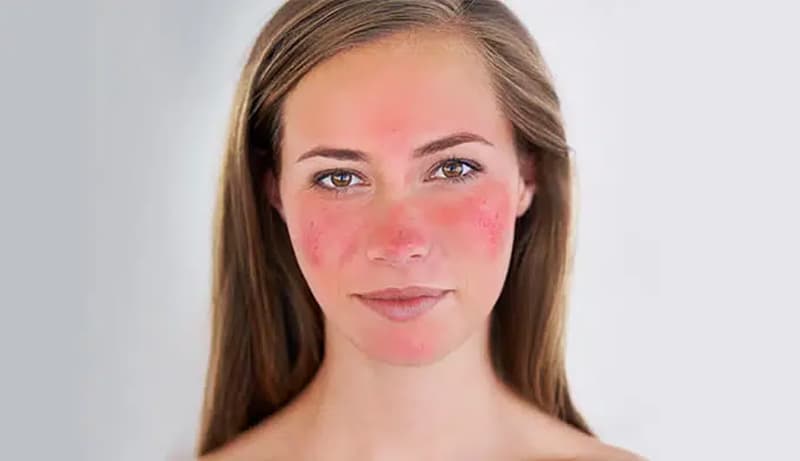 شناخت پوست حساس در شناخت انواع نوع پوست