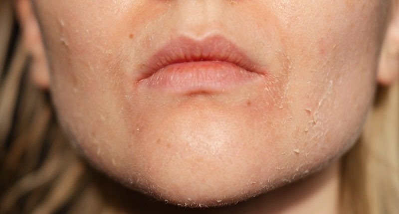 شناخت پوست خشک در انواع نوع پوست